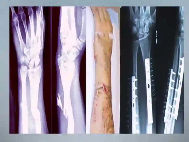 Bone fracture 4