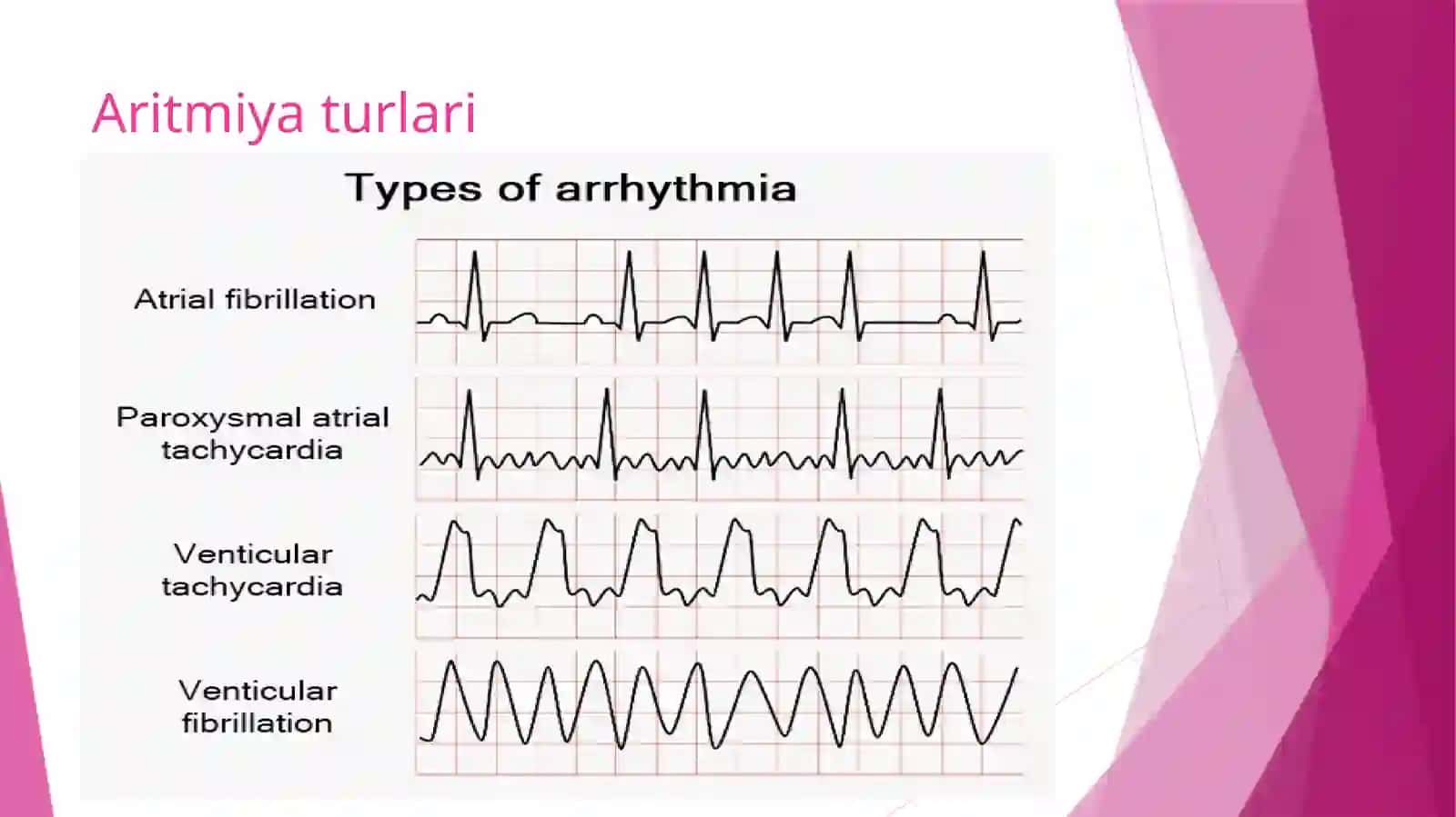 YurakaritmiyalariEKG diagnostikasi 4