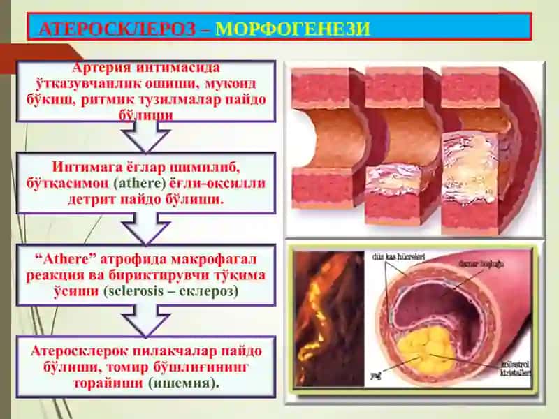 Атеросклероз. Гипертония касаллиги 4