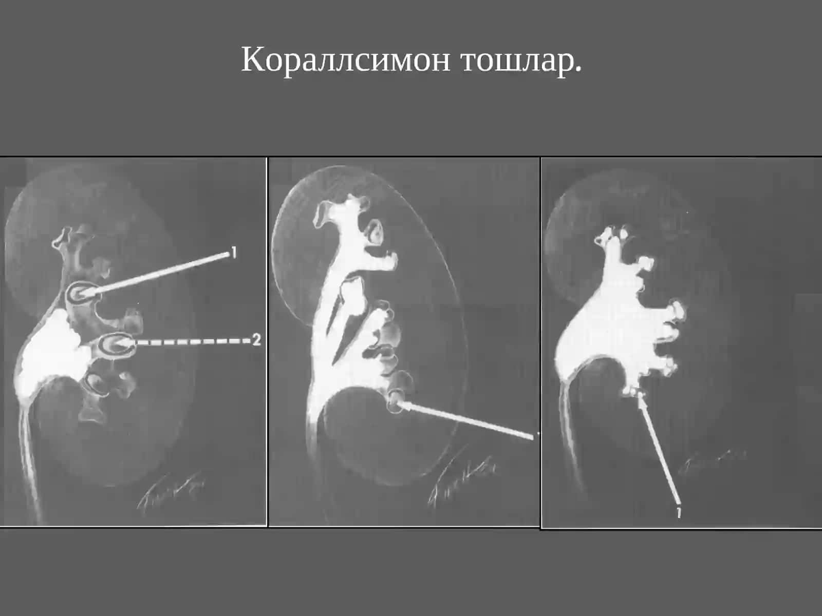 Сийдик тош касаллиги (СТК) 4