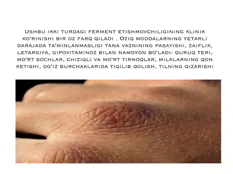 Nasliy fermentopatiyalar 4