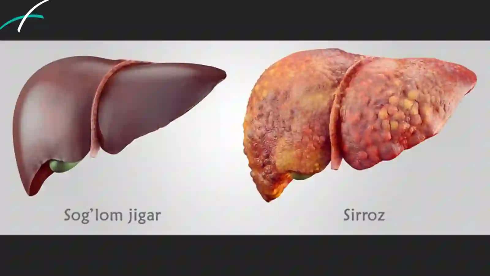 Jigar sirrozi kasalligi 4