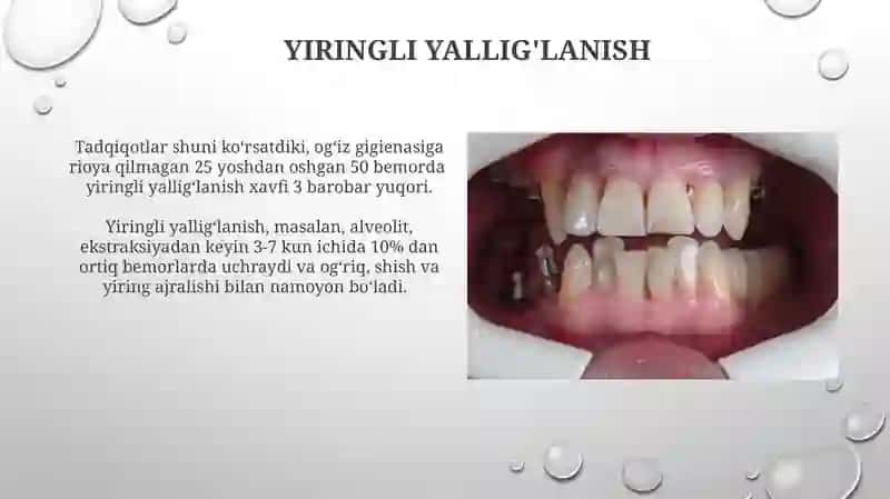 Pulpit va periodontit 4