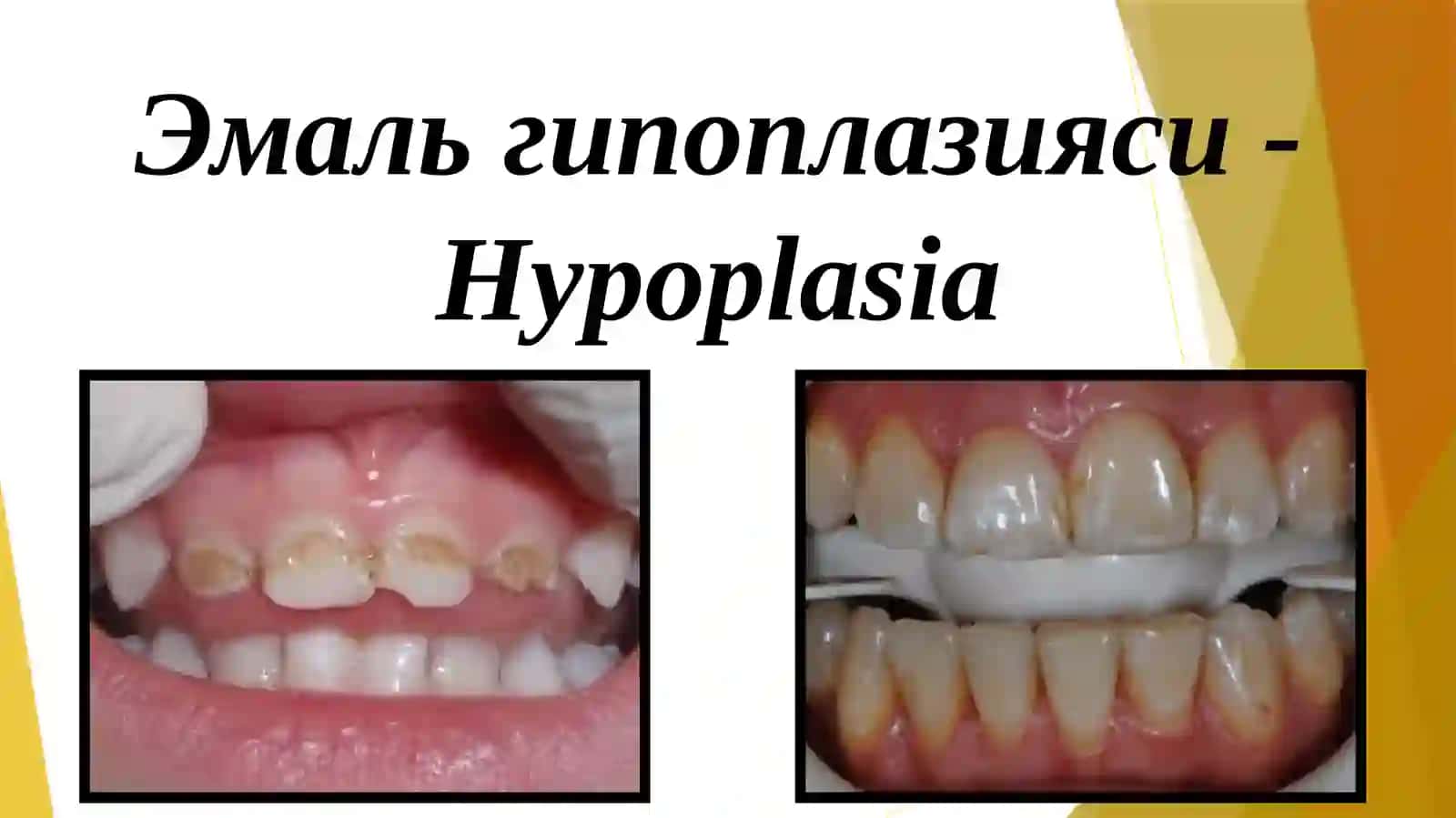 Тиш тожиниг емирилиши, шикастланиши 4
