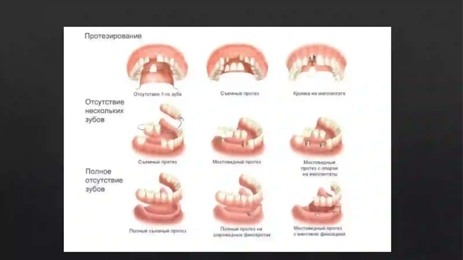 Yuqorijag' dental implantatsiya 4