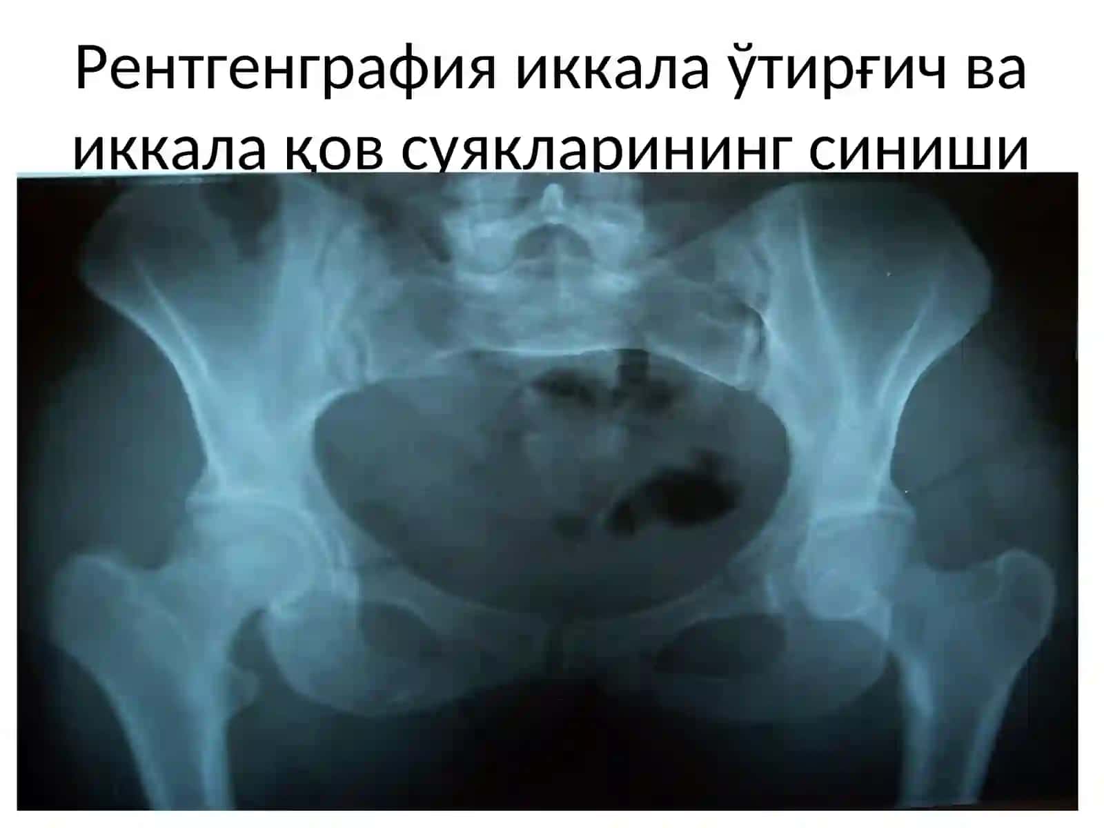Чанок суяклари шикастланишлари 4