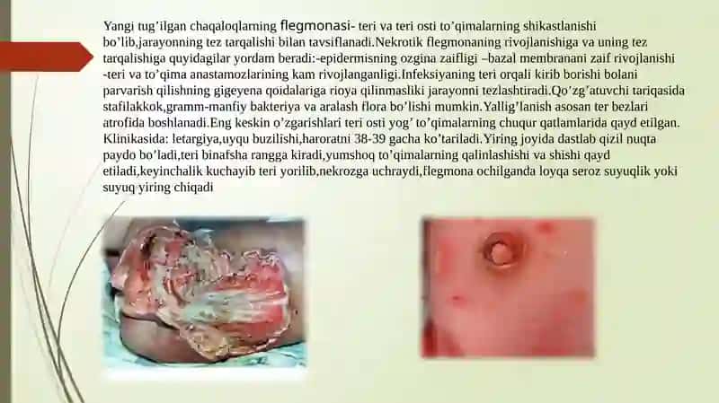 Chaqaloqlarning yiringli-yallig’lanish kasalliklari 4