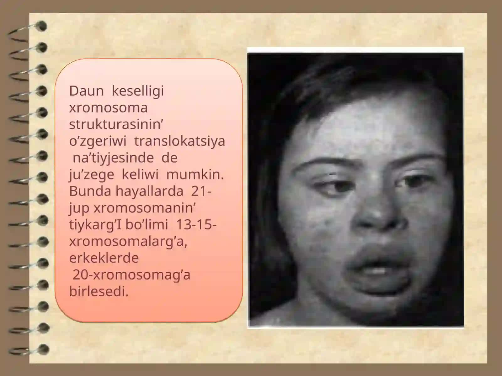 Xromosoma kesellikleri, Daun sindromi 4