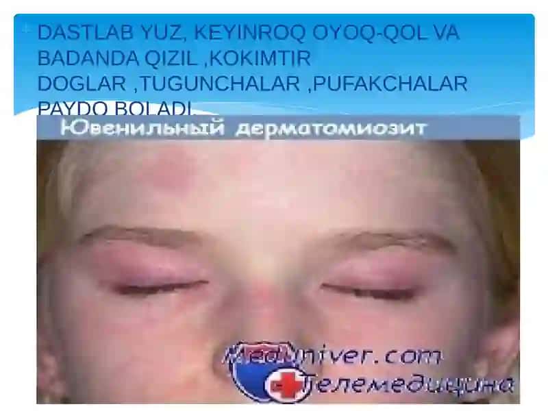 DERMATOMIOZITLAR 4