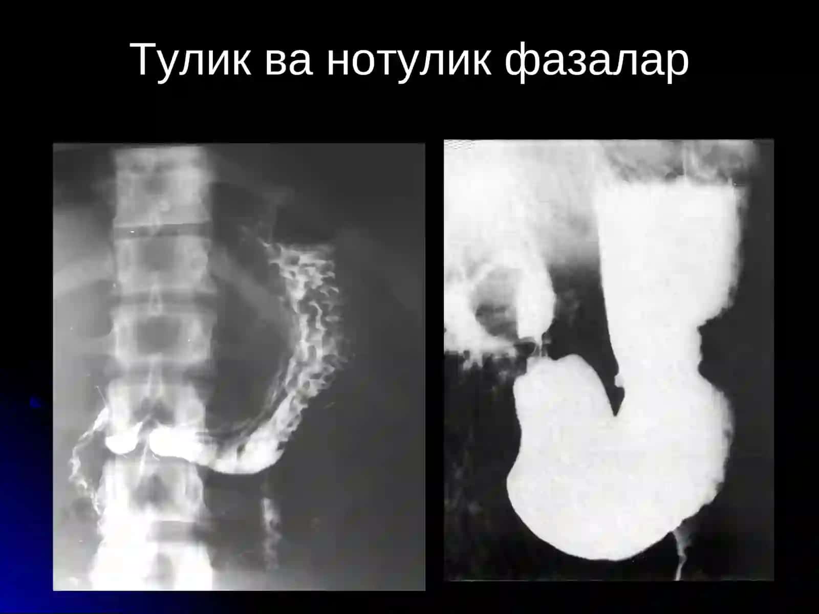 ОШКОЗОН-ИЧАК КАСАЛЛИКЛАРИ НУР ТАШХИСИ 4