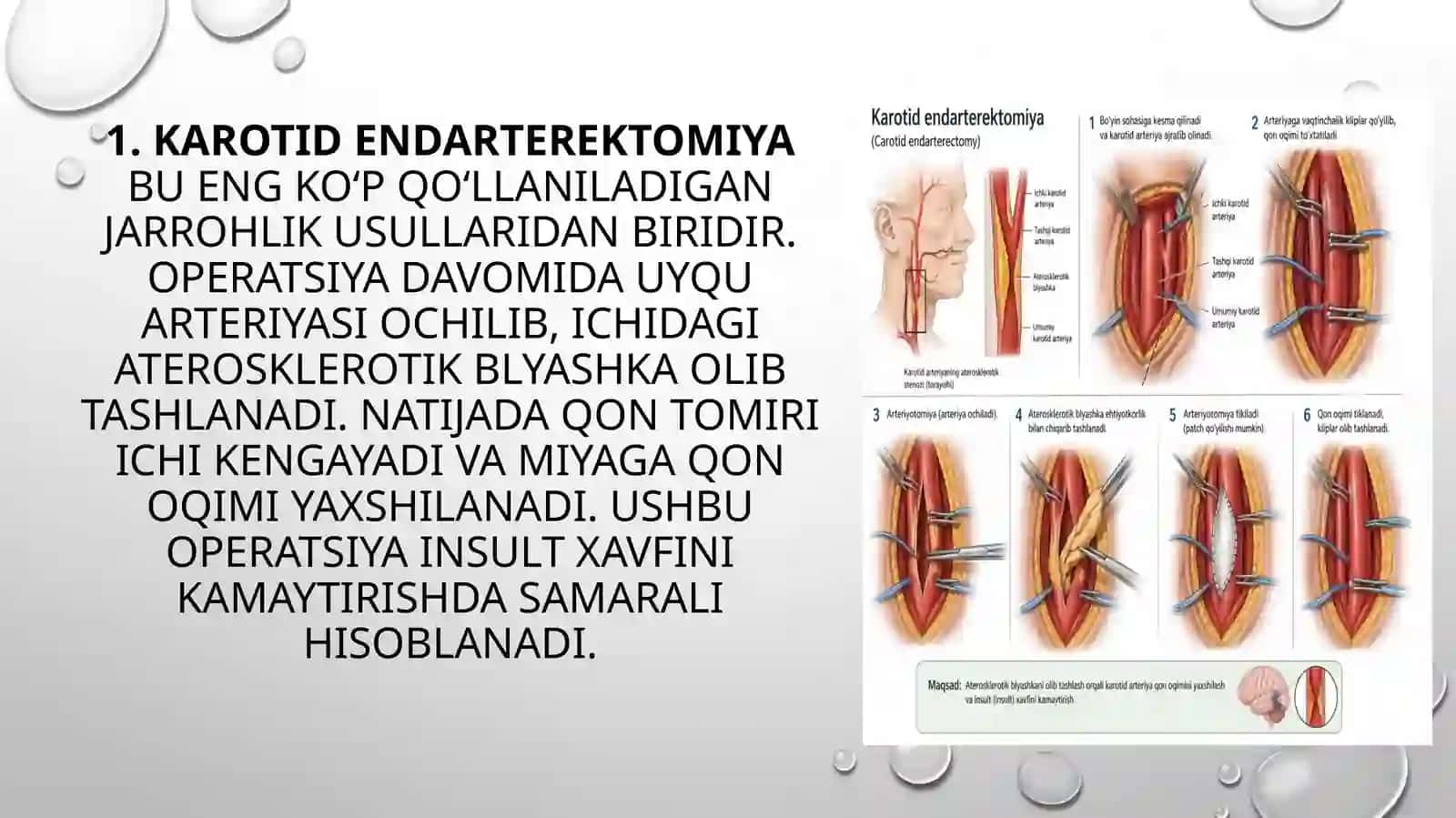 ekstrakranial arteriyalardagi zamonaviy operatsiyalar 4