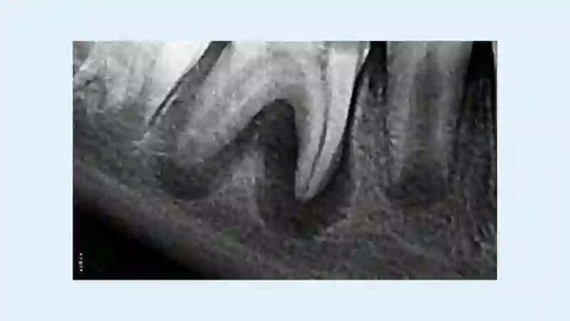 SURUNKALI PERIODONTITLARNING PATOLOGIK ANATOMIYASI 4