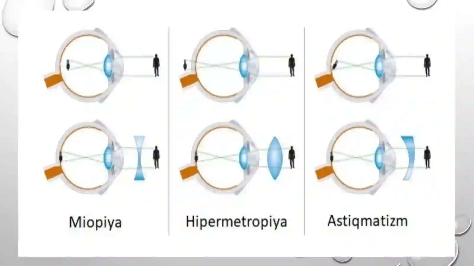 Refraksiyani zamonaviy korreksiya va davolash usullari 4