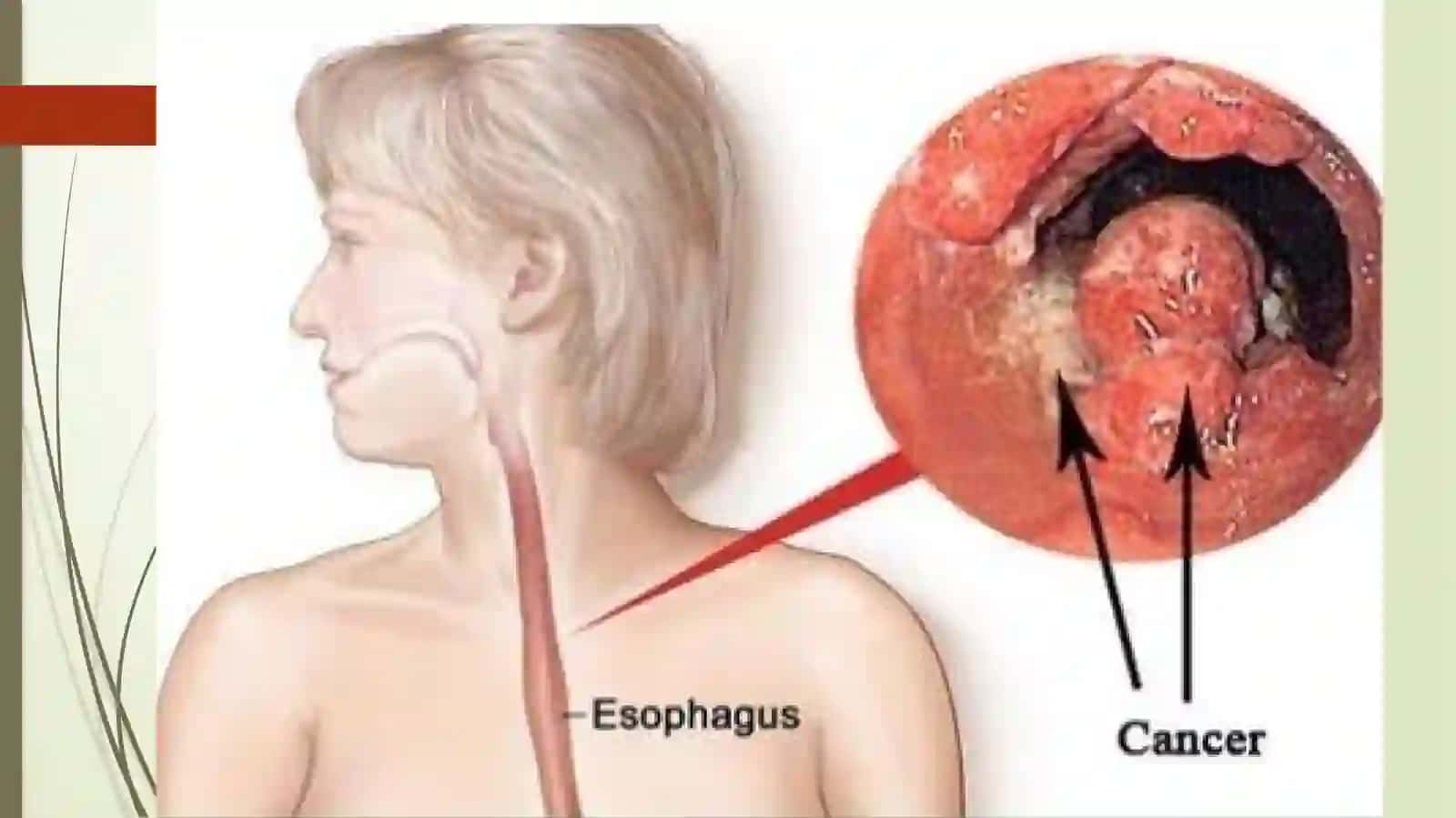 Qizilo‘ngach adenomasi (Adenoma oesophagi) 4