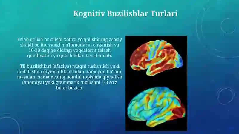Alzheymer kasalligining kognitiv buzilishlar 4