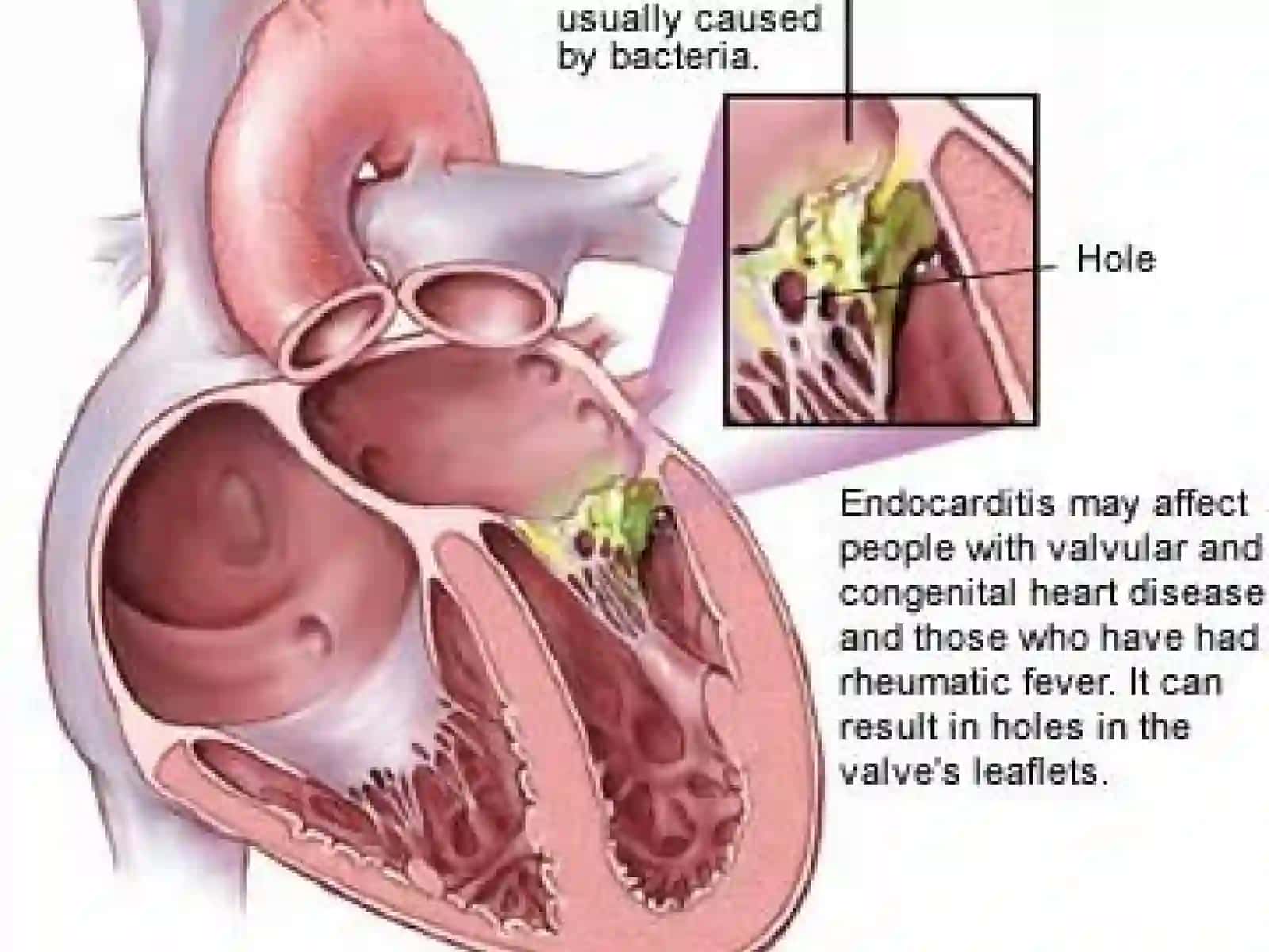 INFECTIVE ENDOCARDITIS 4