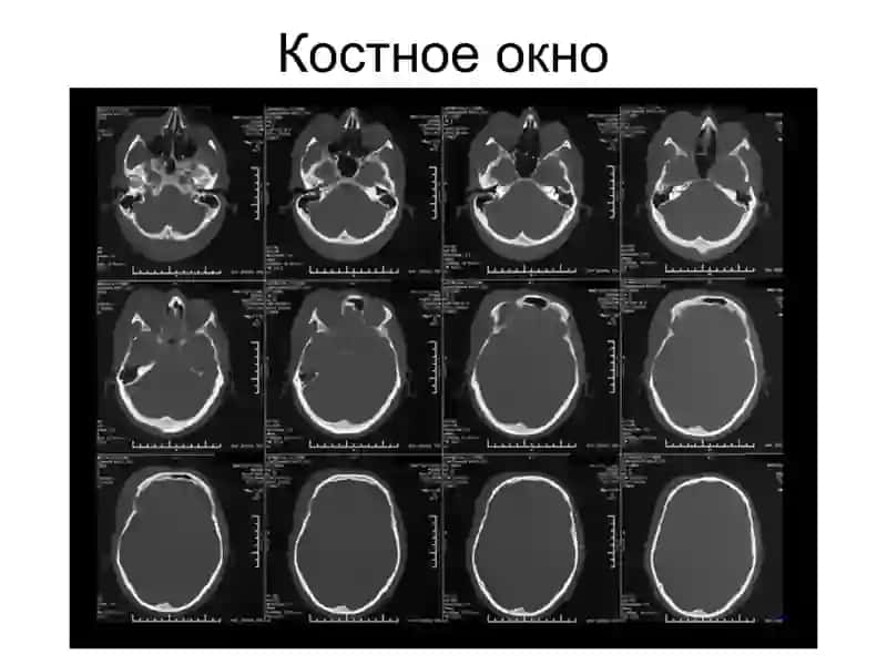 КТ, МРТ головного мозга 4