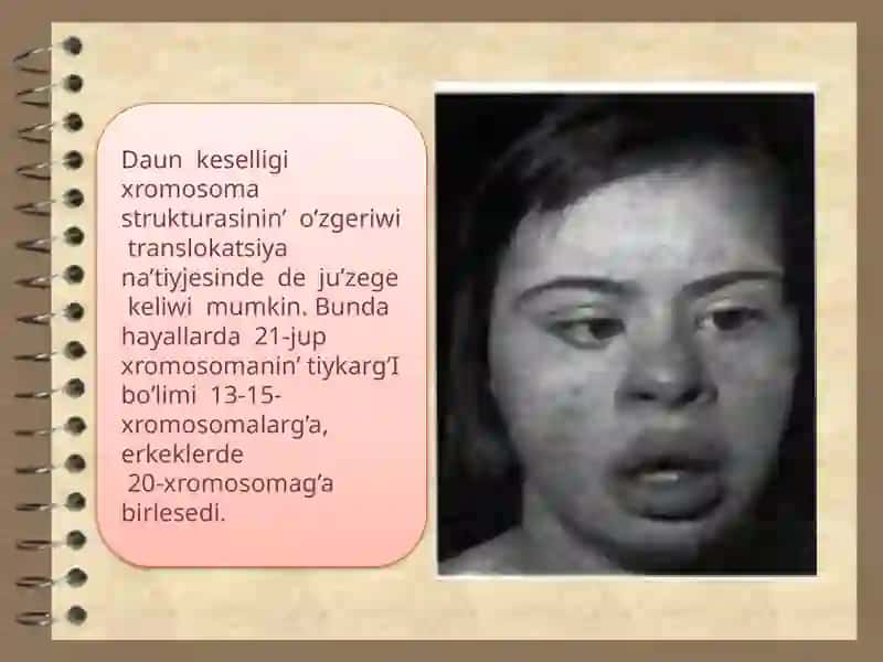 Xromosoma kesellikleri, Daun sindromi 4