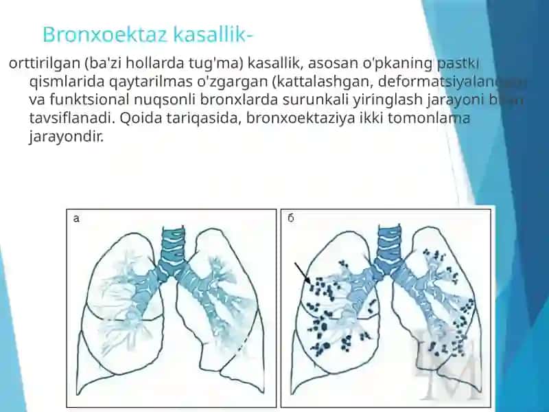 Bronxoektazkasallik 4