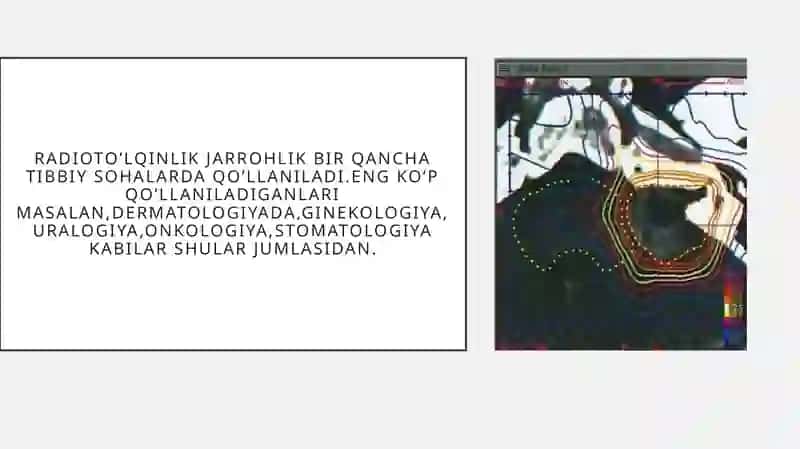 Radioto’lqinli jarrohlik 4
