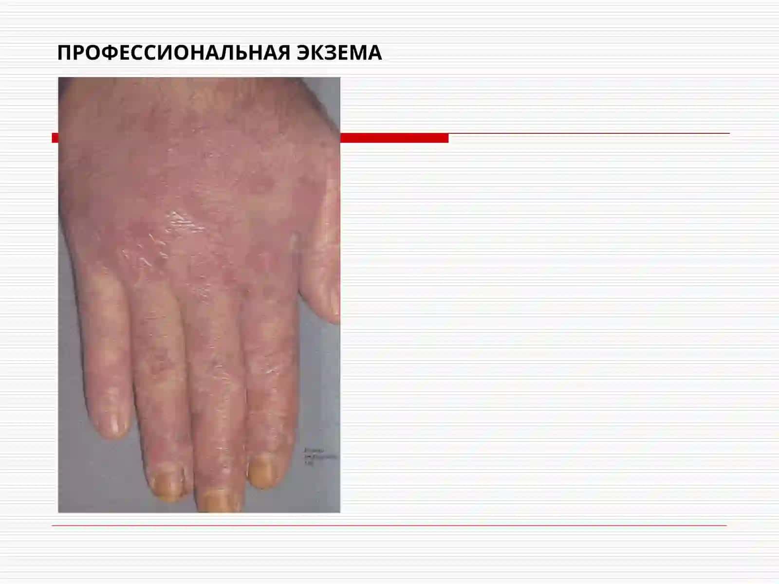 Allergo va neyrodermatozlar 4
