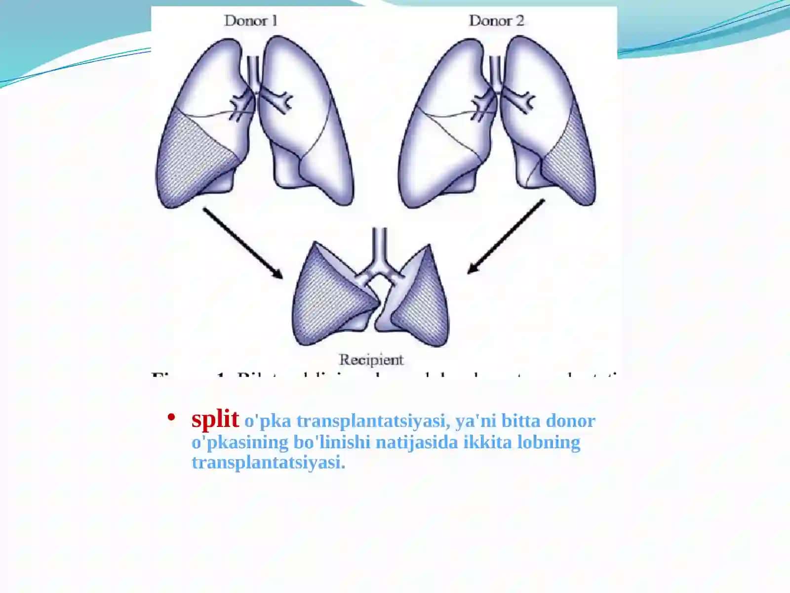 O'pka transplantatsiyasi 4