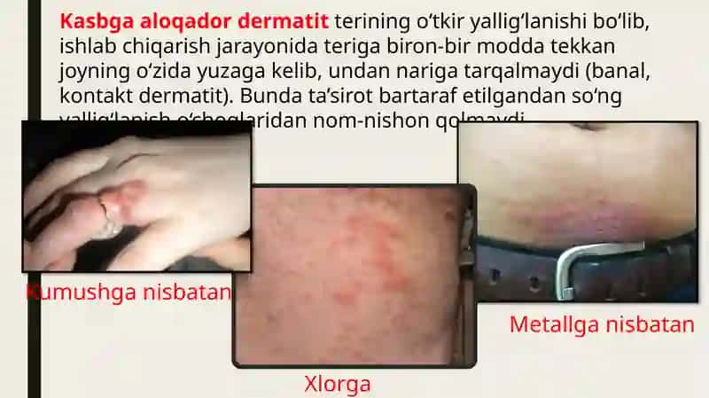 Kasbga aloqador dermatozlar 4