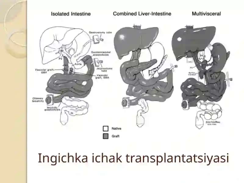 ICHAK TRANSPLANTOLOGIYASI 4
