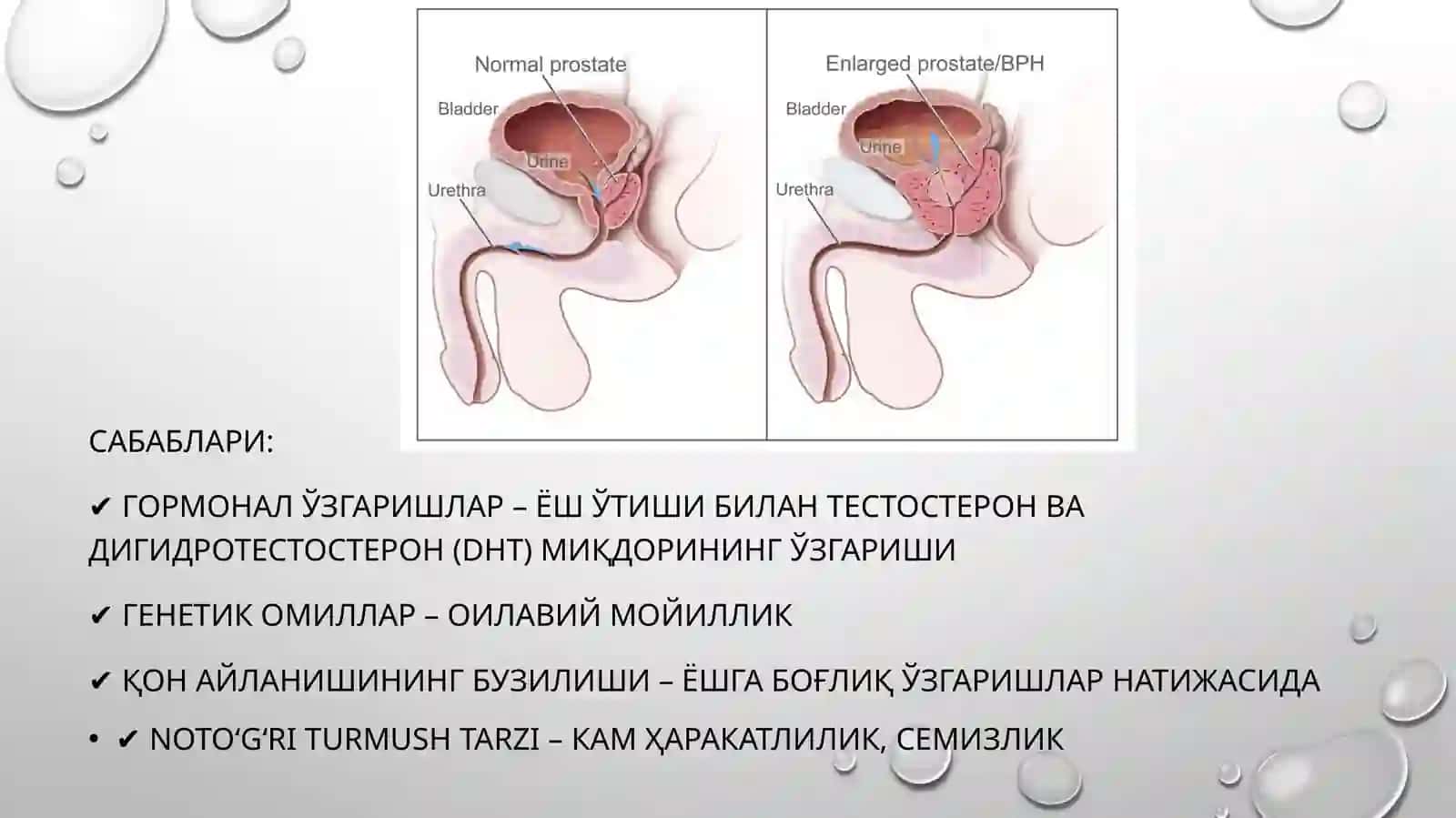 Prostatabezining xavfsiz giperplaziyasi (adenoma) 4