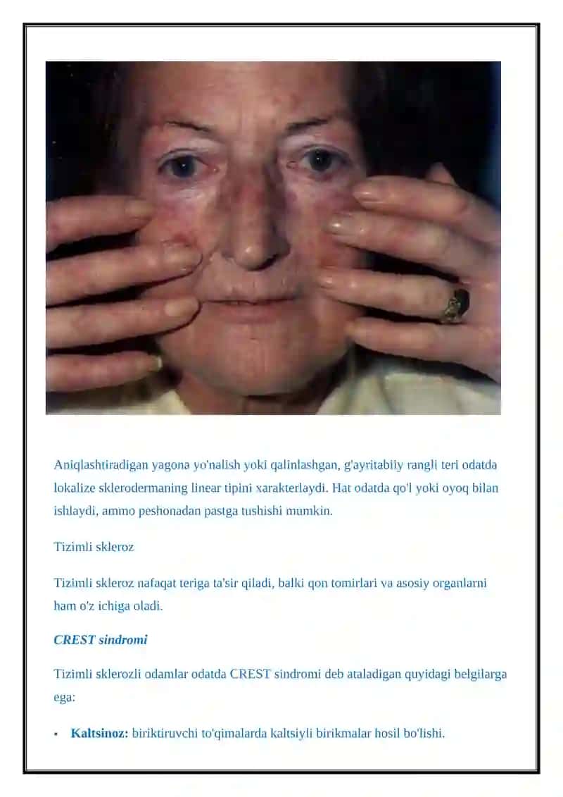Sklerodermiya 4
