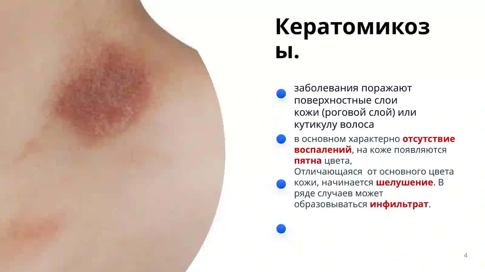 Грибковые заболевания кожи 4