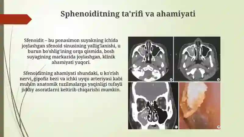 O'tkir yiringli sfenoidit 4