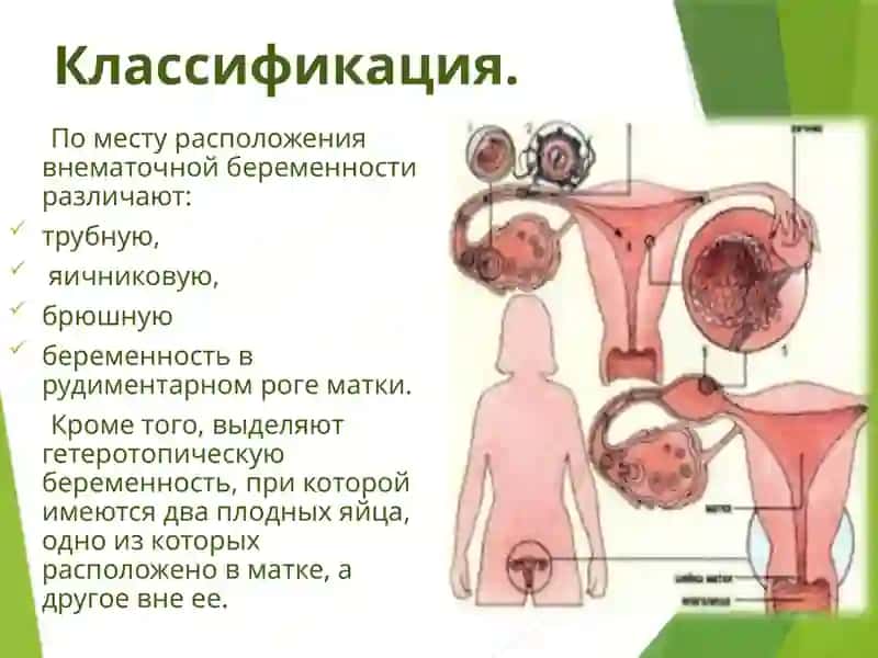 Внематочная беременность 4