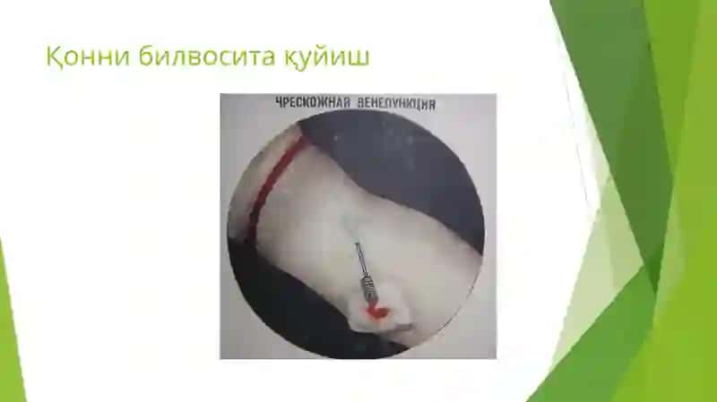 Қон қуйиш усуллари 4