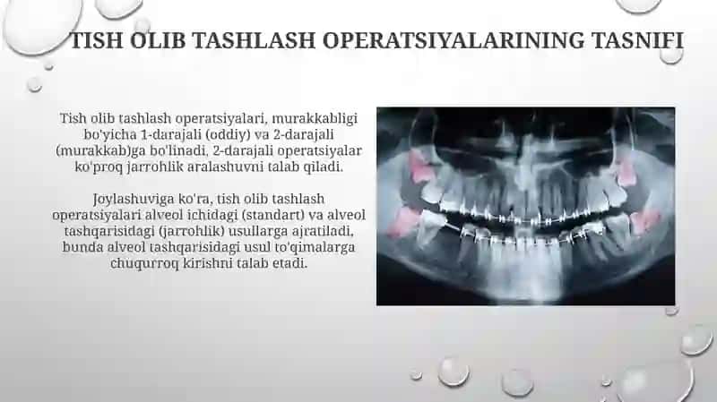 Tisholish operatsiyalari 4