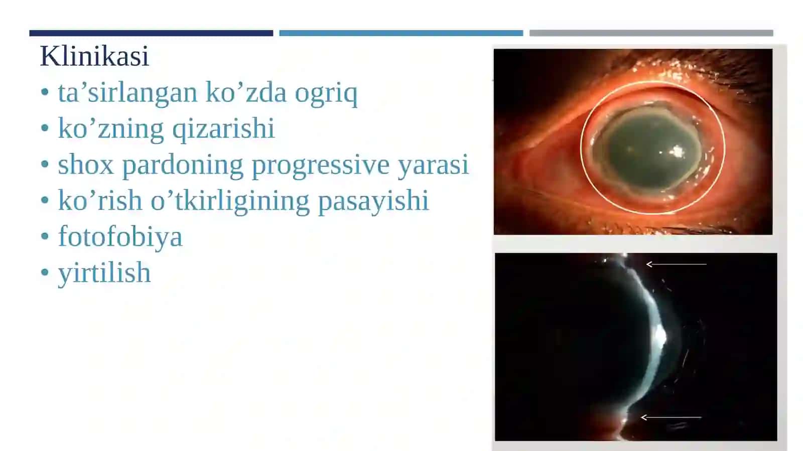 Noaniq etiologiyali keratitlar 4