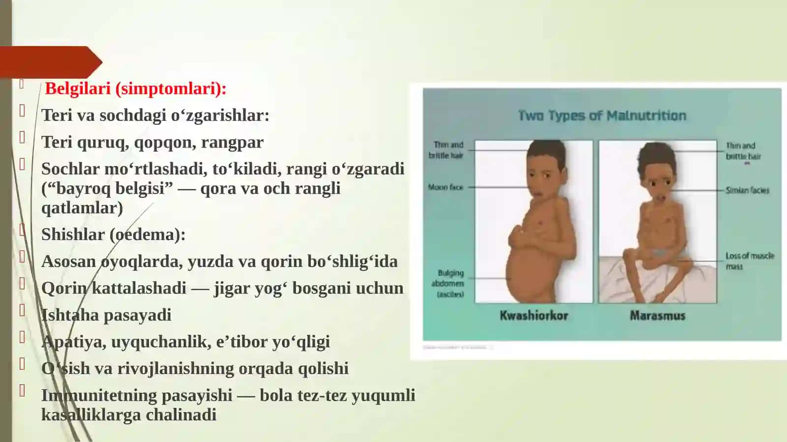 Kvashior sindiromi etiologiyasi patagenezi haqida. 4