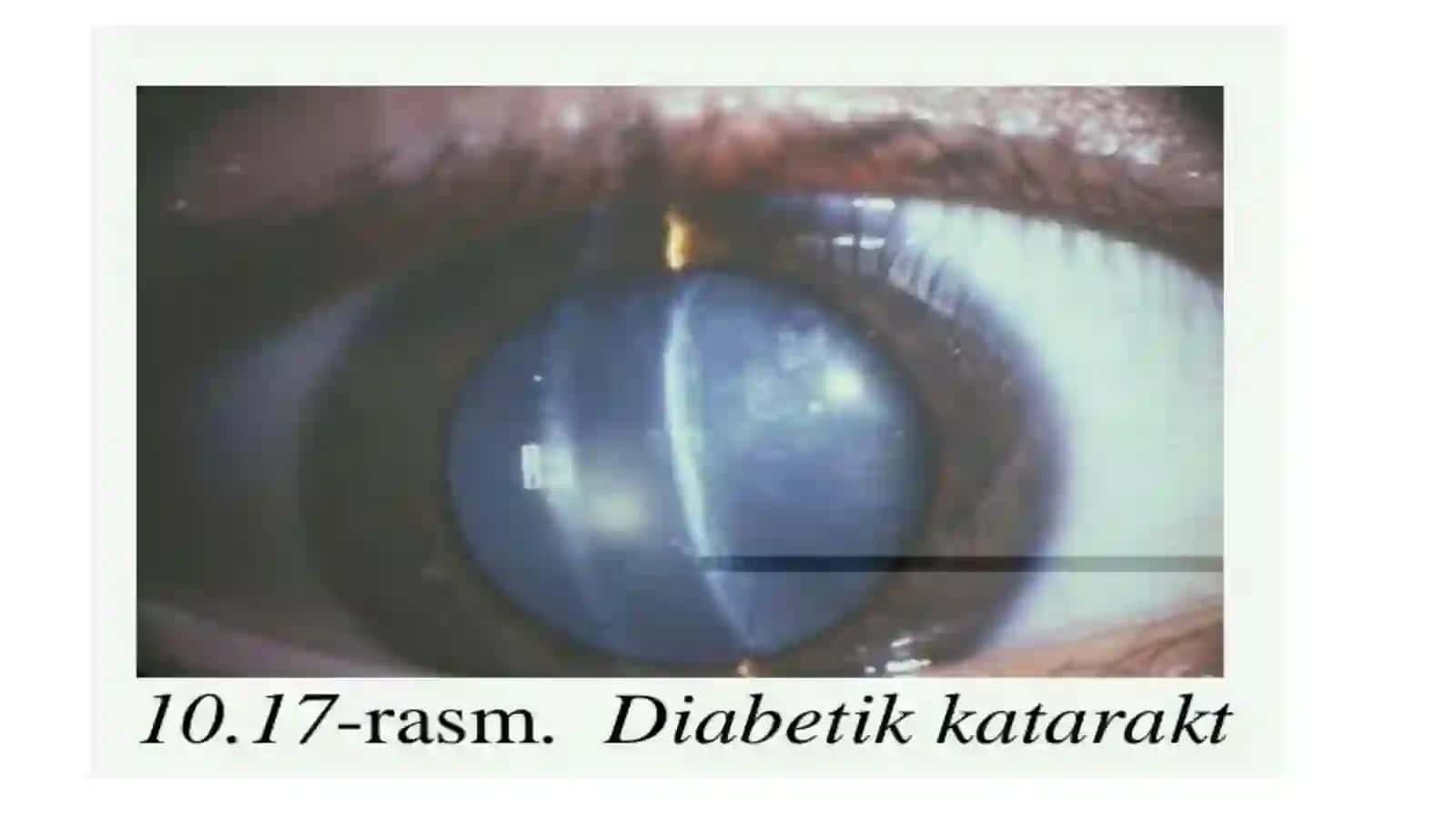 Diabetik katarakta 4