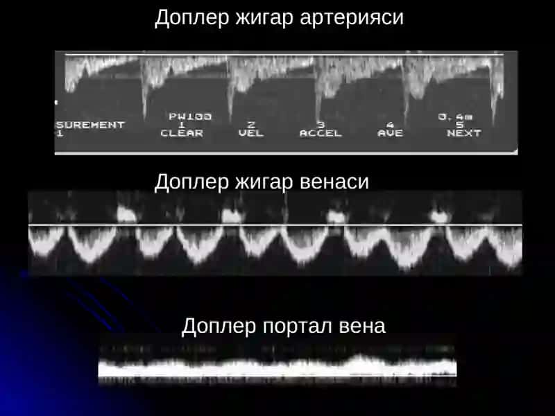 ЖИГАР КАСАЛЛИКЛАРИ НУР ТАШХИСИ 4