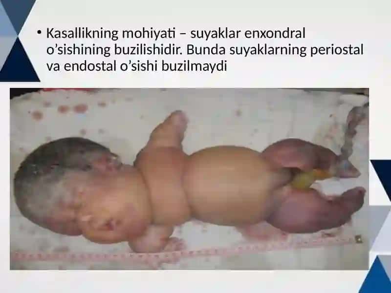 Xondrodistrofiyalar 4