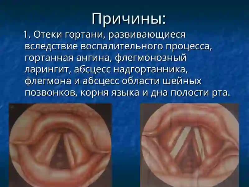 ОСТРЫЕ И ХРОНИЧЕСКИЕ ЗАБОЛЕВАНИЯ ГОРТАНИ 4