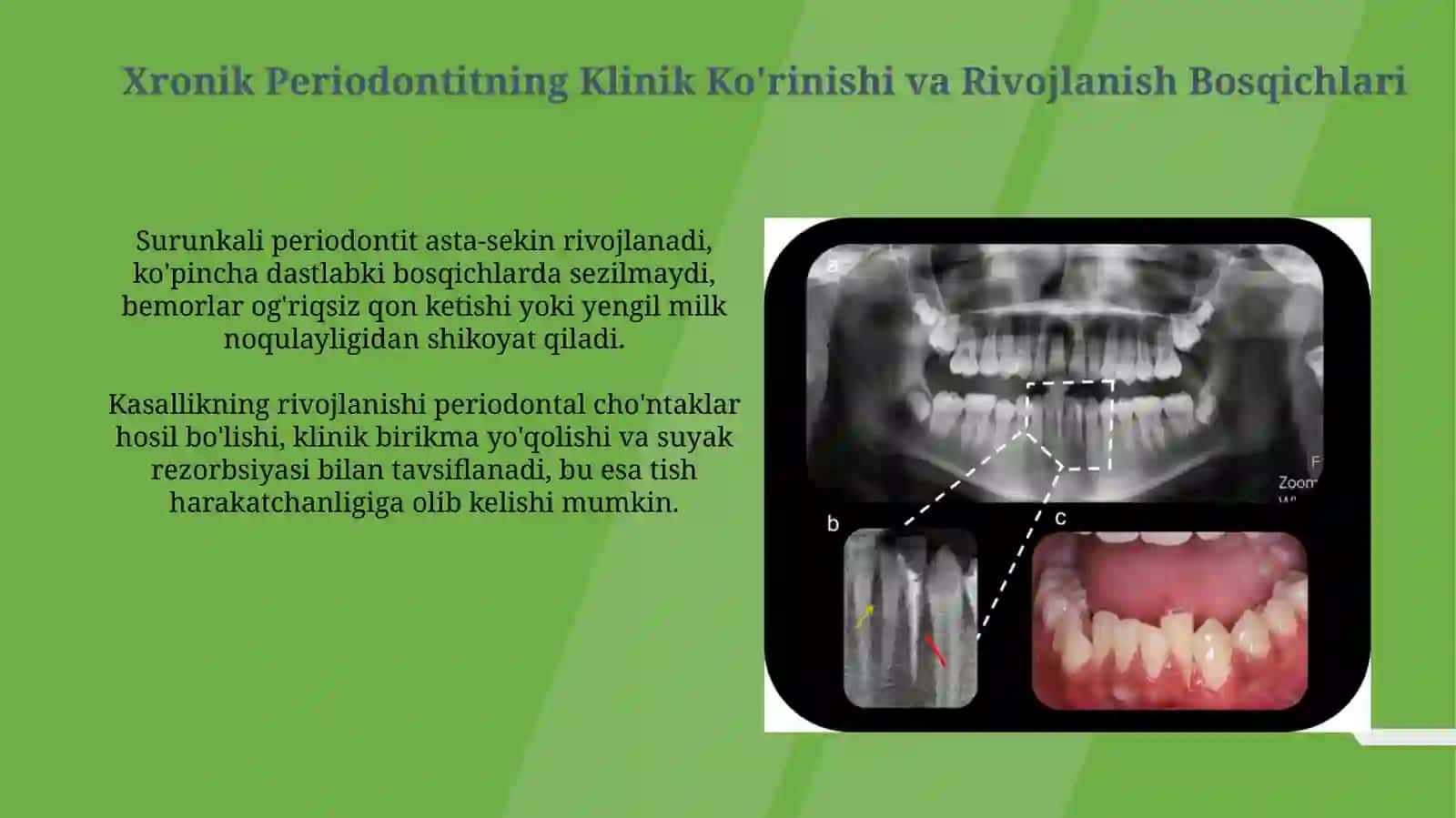 Surunkali periodontitlar klinik kechishi 4