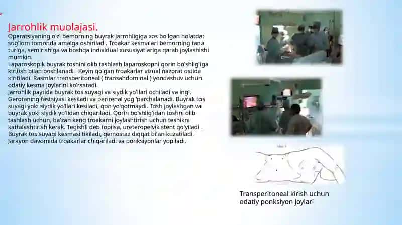 Urologiyada laparoskopik operatsiyasi 4