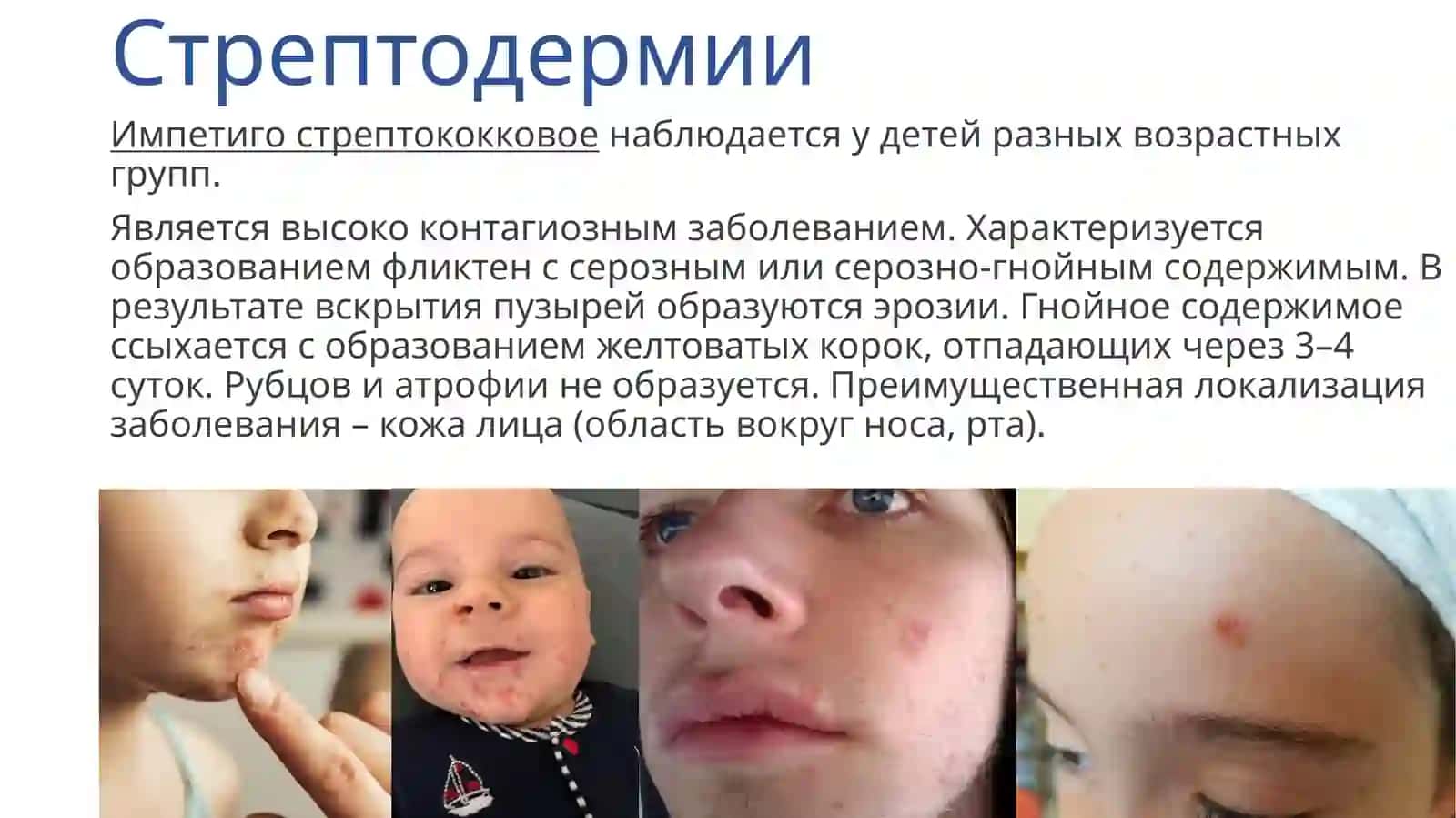 Стрептодермии 4