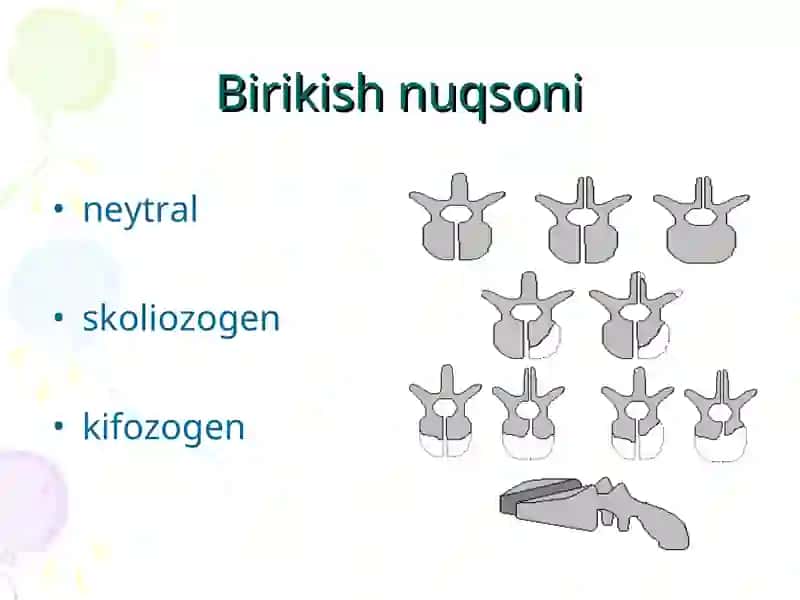 Umurtqaning rivojlanish nuqsonlari 4