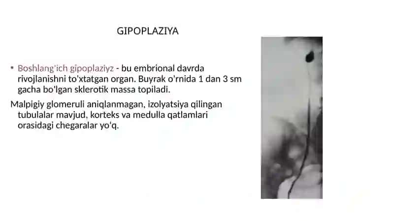 Buyraklar Tug’ma Nuqsonlari 4