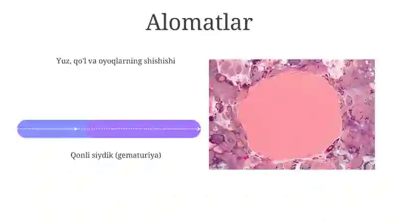 Glamerulonefrit 4