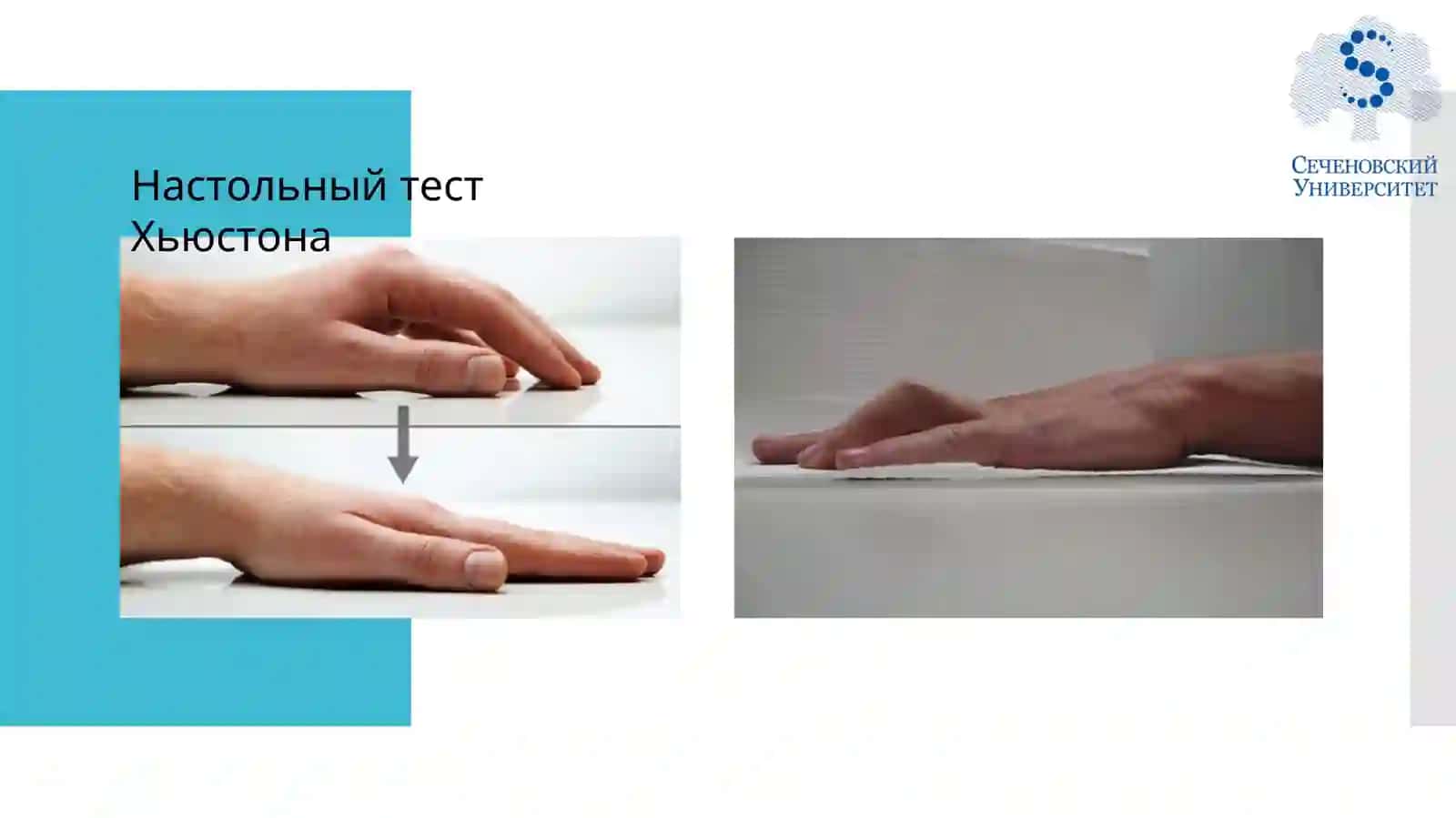 Методы лечения контрактуры Дюпюитрена 4