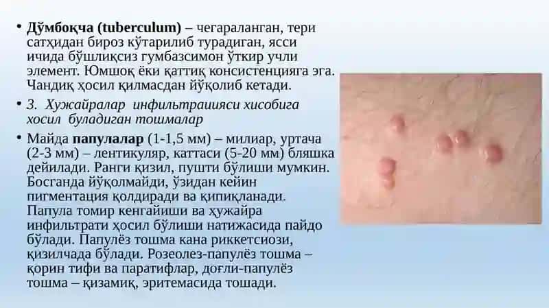 Розеола (rozeola) 4