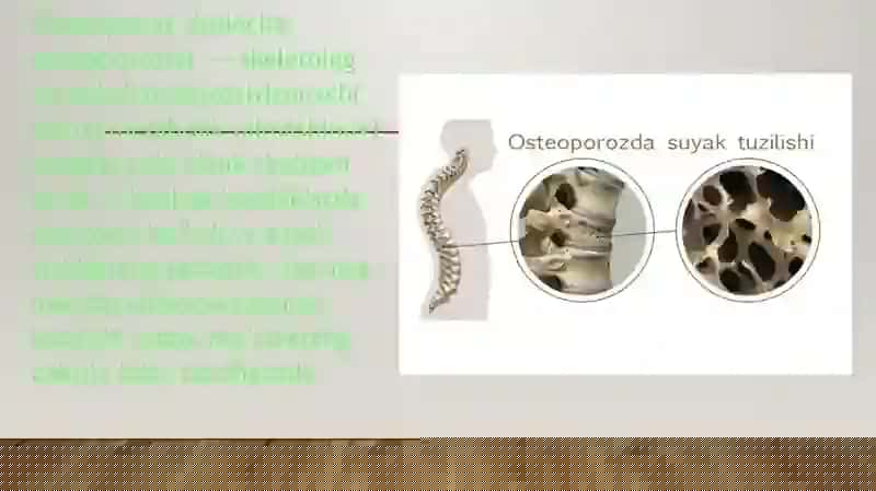 Osteoporoz kasalliklari 4